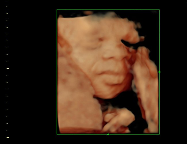 3D ultrasound image at 28 weeks